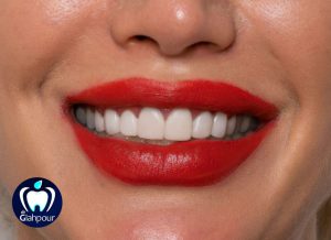 بلیچینگ دندان در کلینیک دنتال ایرانیان