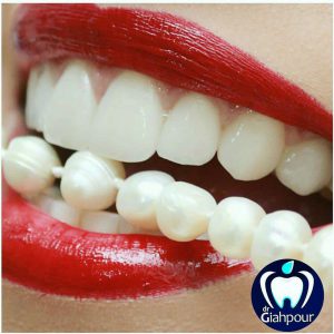 سفید شدن طبیعی دندان ها با روش بلیچینگ